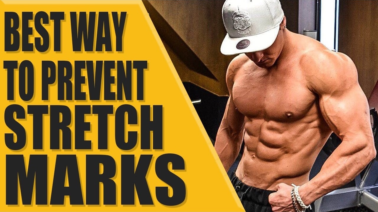 Best way to prevent stretch marks